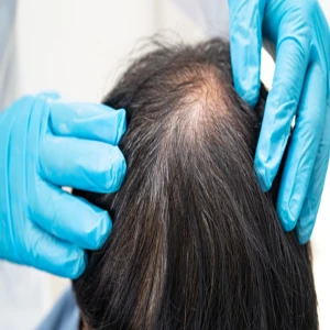 Tıpta yeni sayfa açacak çalışma! Kellik probleminin sonu mu geliyor