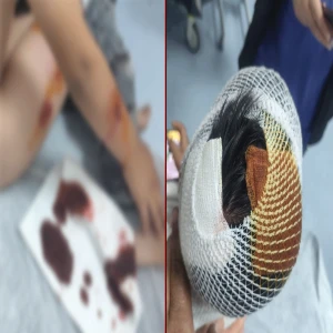 Şanlıurfa’da yine köpek dehşeti! Yine çocuk yaralandı