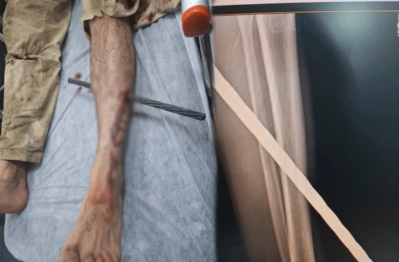 İnşaat demiri bacağına saplandı