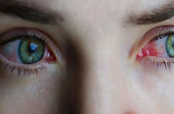 Gözlerin gizli düşmanı!