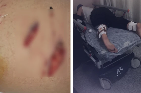 Şanlıurfa’da bir başıboş köpek dehşeti daha: