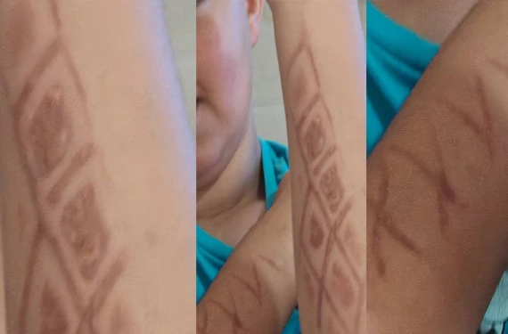 Sıcak yüzey tehlikesi