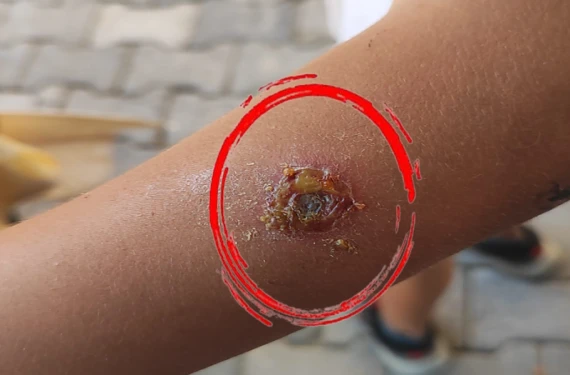 Ömür boyu izi gitmiyor