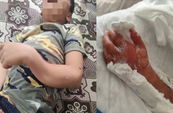 Çocuk kangren oldu...