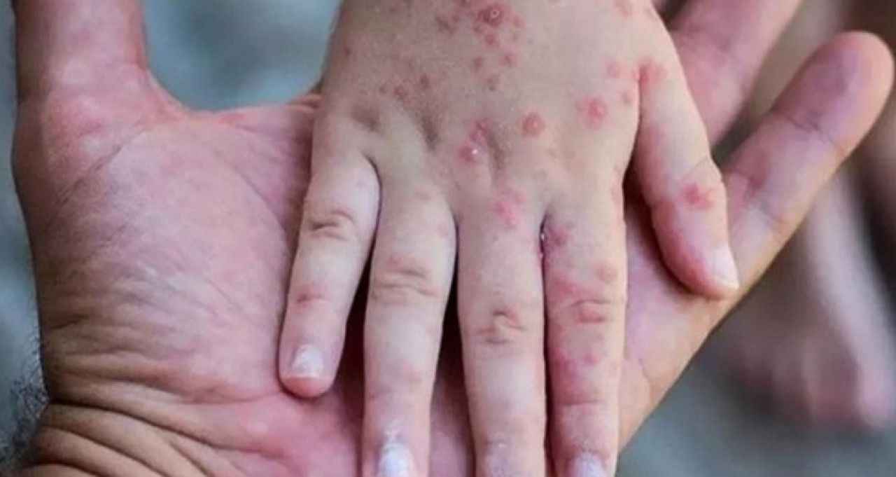 Bakan Koca'dan maymun çiçeği virüsü açıklaması