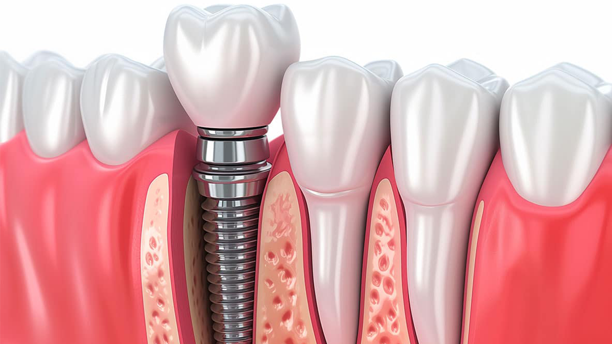 İmplant tedavisi ücretsiz oluyor! Teklif Meclis'e sunuldu