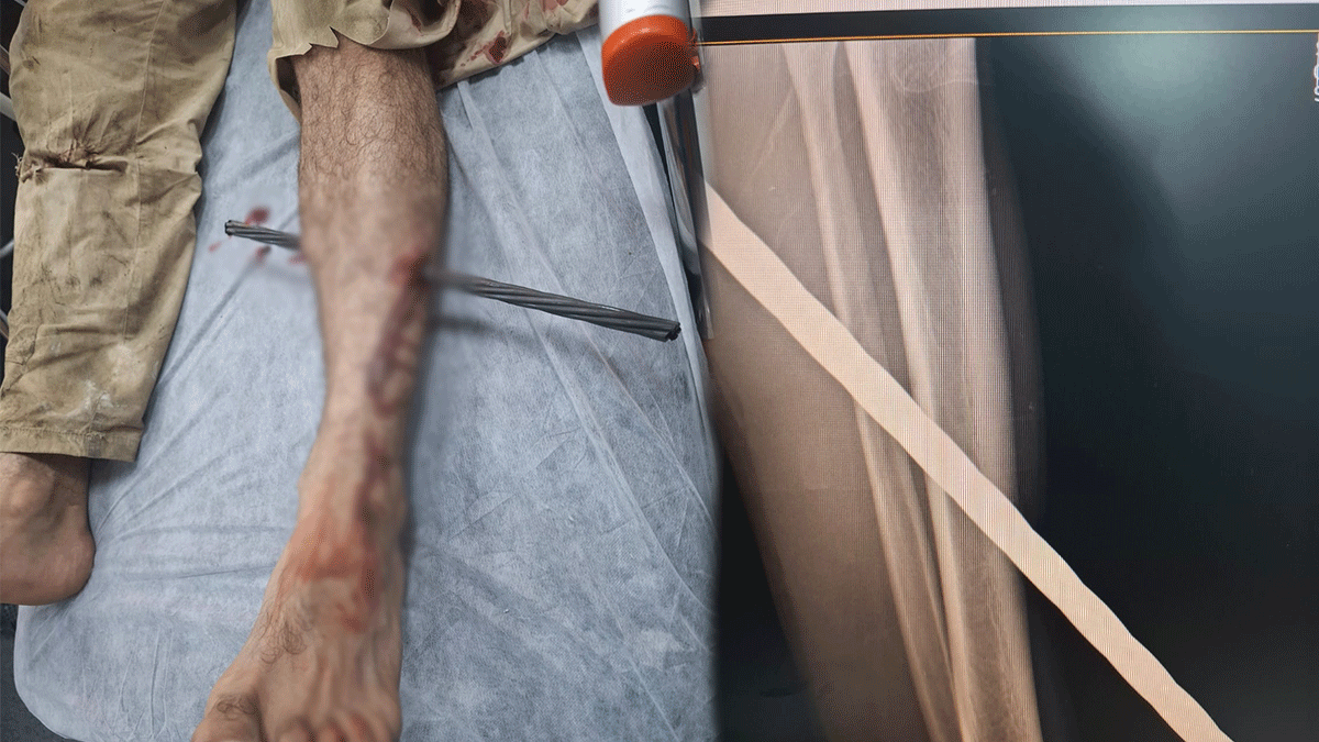 Şanlıurfa’da feci iş kazası! İnşaat demiri bacağına saplandı