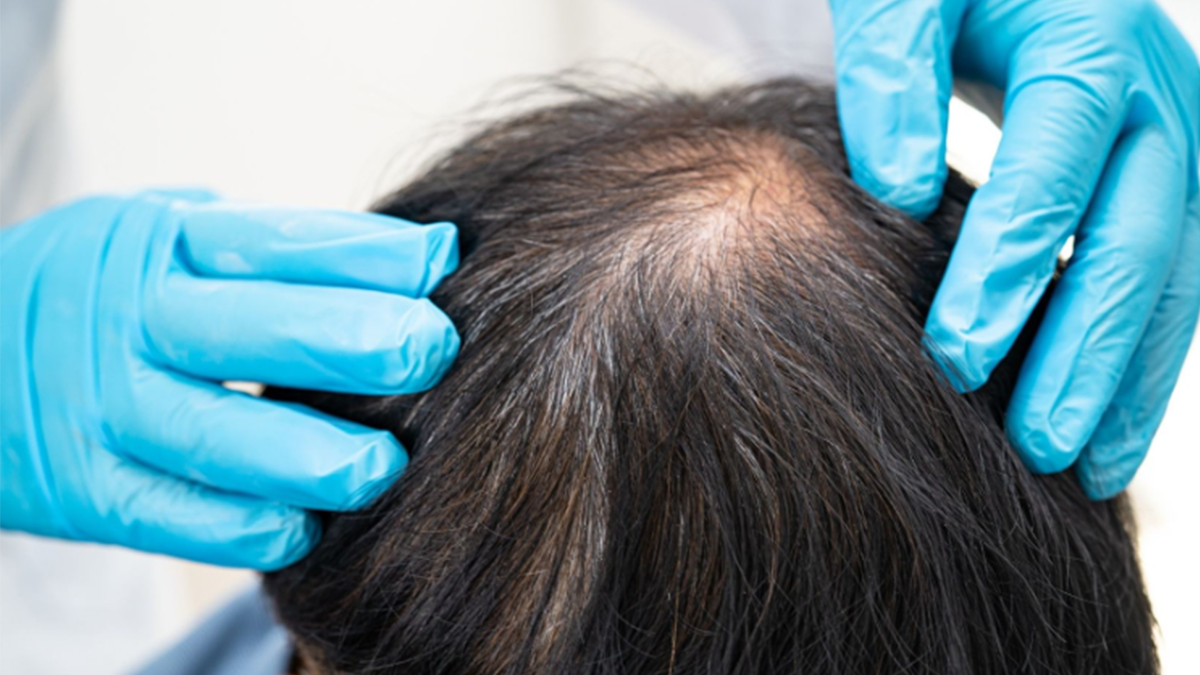 Tıpta yeni sayfa açacak çalışma! Kellik artık tarihe mi karışıyor?