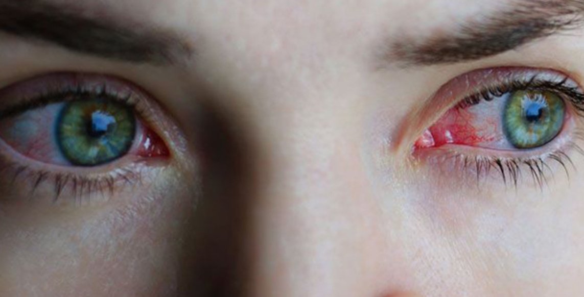 Gözlerin gizli düşmanı! Uzmandan uyarı