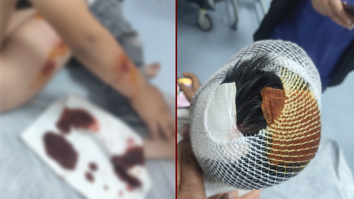 Şanlıurfa’da yine köpek dehşeti! Yine çocuk yaralandı