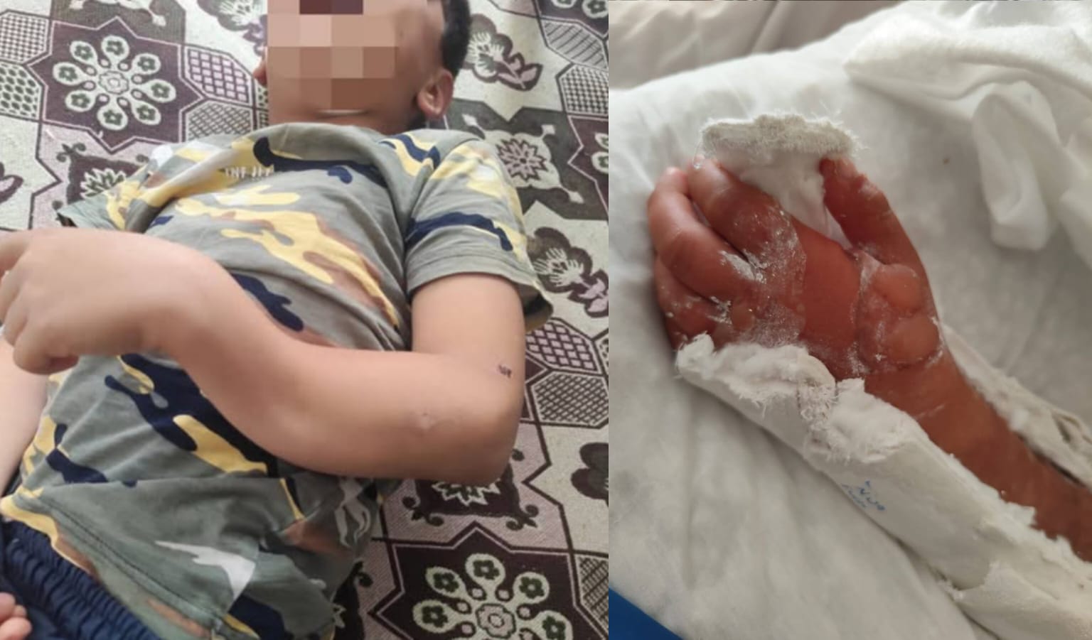 Şanlıurfa'da yanlış tedavi iddiası! Çocuk kangren oldu...